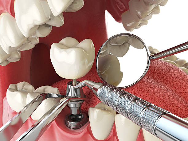 Best Knocked-Out Tooth (Avulsed Tooth) Treatment in Hollywood Park, TX